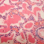 Набряк легень